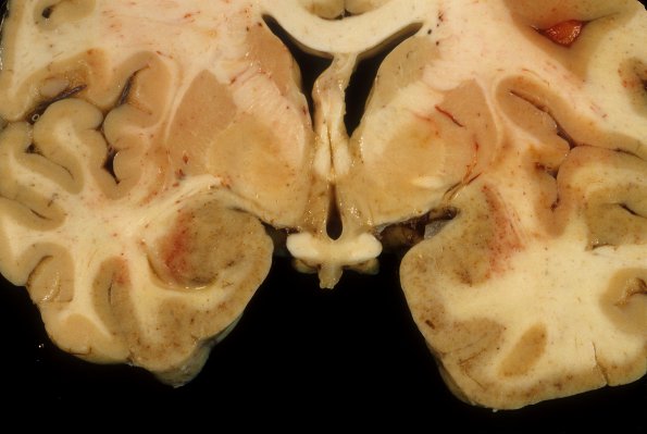 1E3 Adenovirus Encephalitis (Case 1) A4