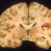 1E4 Adenovirus Encephalitis (Case 1) A2