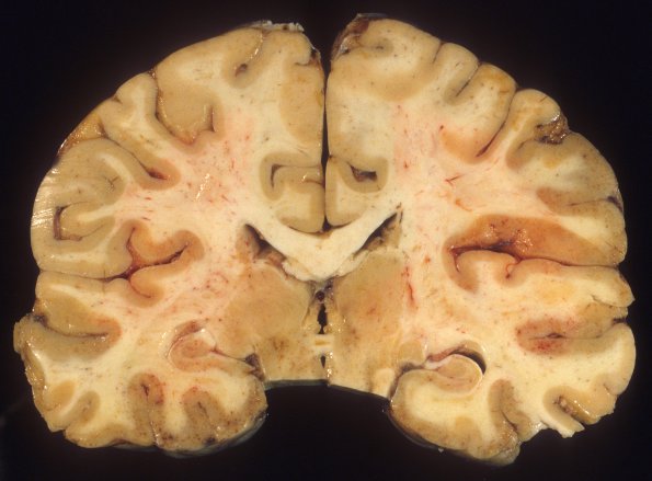 1E4 Adenovirus Encephalitis (Case 1) A2