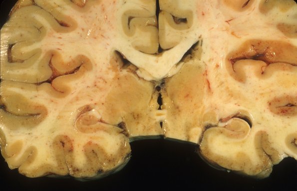 1E5 Adenovirus Encephalitis (Case 1) A11