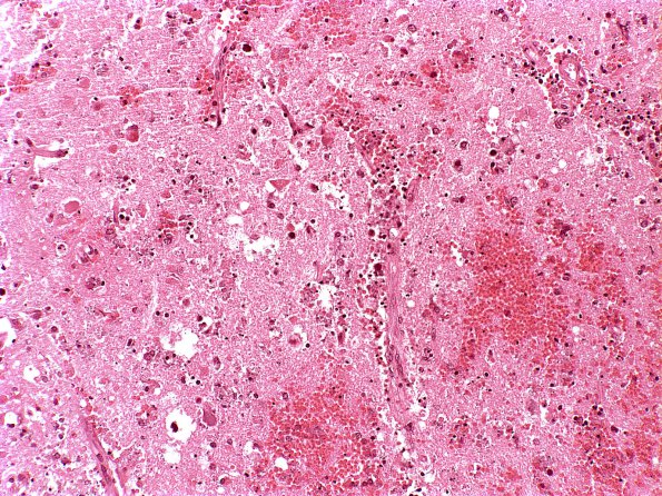 1F3 Adenovirus Encephalitis (Case 1) 9