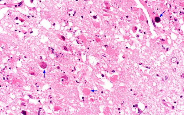 1F4 Adenovirus Encephalitis (Case 1) H&E 19 copy