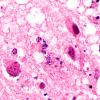 1F5 Adenovirus Encephalitis (Case 1) H&E 22