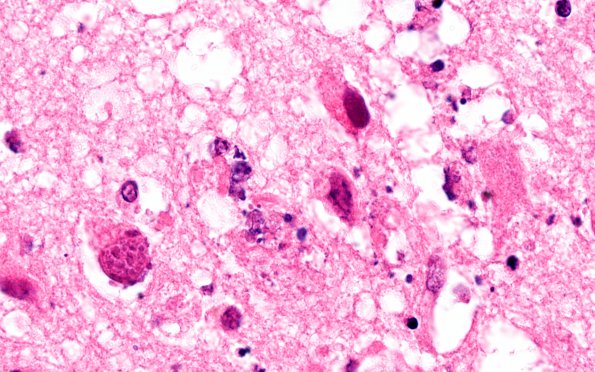 1F5 Adenovirus Encephalitis (Case 1) H&E 22