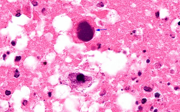 1F6 Adenovirus Encephalitis (Case 1) H&E 14 copy