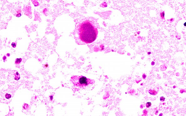 1F7 Adenovirus Encephalitis (Case 1) H&E 15