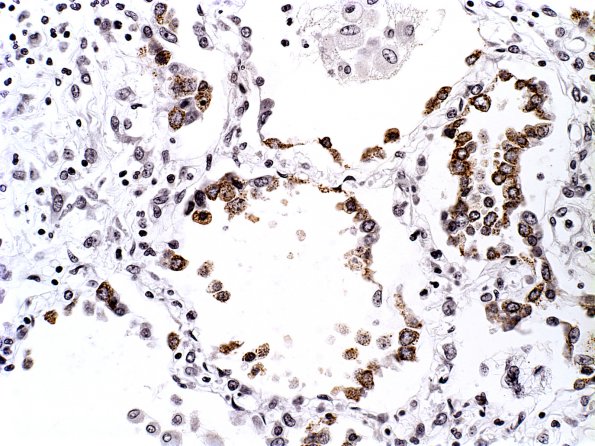 1G1 Adenovirus Encephalitis (Case 1) b lung AdenoV