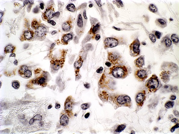 1G2 Adenovirus Encephalitis (Case 1) lung AdenoV