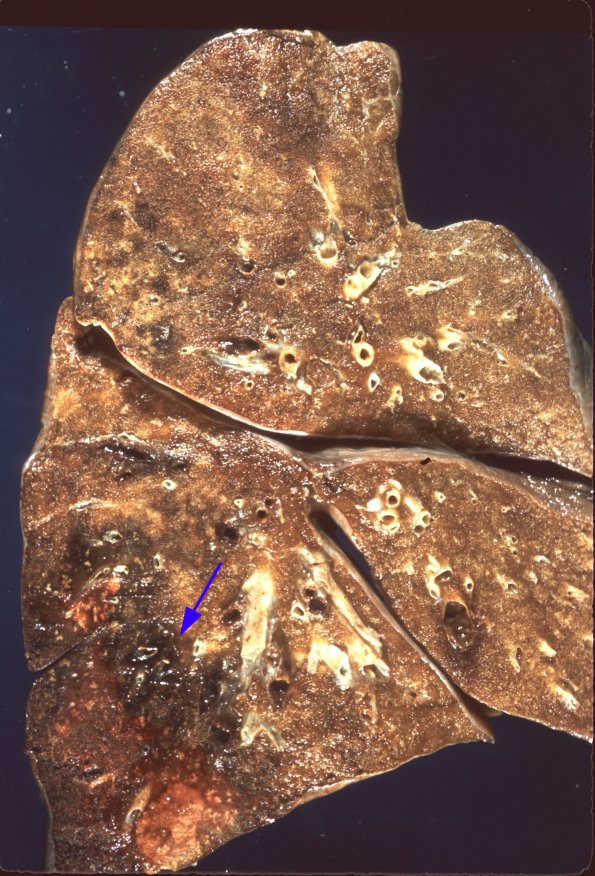 2 Adenovirus, lung (Case 2) gross 1 copy