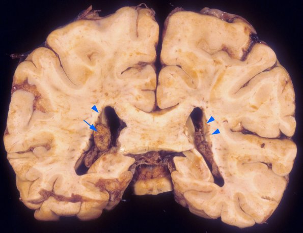 1A3 CMV (Case 1) Gross 1 copy