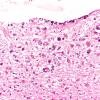 1B3 CMV (Case 1) Ependymitis N14 H&E 2