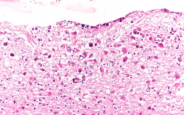 1B3 CMV (Case 1) Ependymitis N14 H&E 2