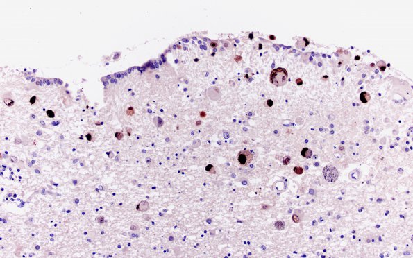 1B4 CMV (Case 1) Ependymitis N14 Anti-CMV