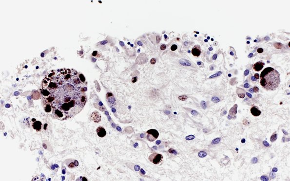 1B5 CMV (Case 1) Ependymitis Immuno 3