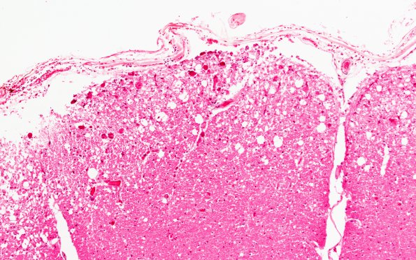 1C2 CMV (Case 1) Spinal cord rim