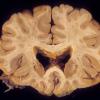 2A1 CMV encephalitis, AIDS (Case 2) 2