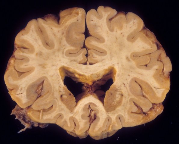 2A1 CMV encephalitis, AIDS (Case 2) 2