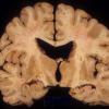 3A CMV Encephalomyelitis (Case 3) 1