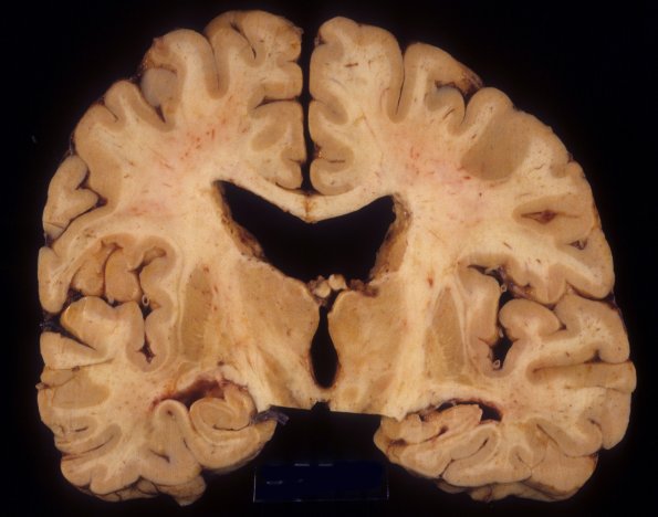 3A CMV Encephalomyelitis (Case 3) 1