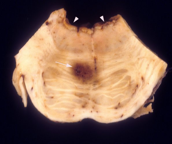 3A3 CMV, pons (Case 3) gross