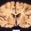 4 CMV encephalitis-ependymitis (Case 4) 2 copy