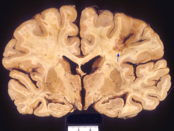 4 CMV encephalitis-ependymitis (Case 4) 2 copy