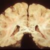 5A2 CMV Encephalitis SP lung transplant (Case 5) 2