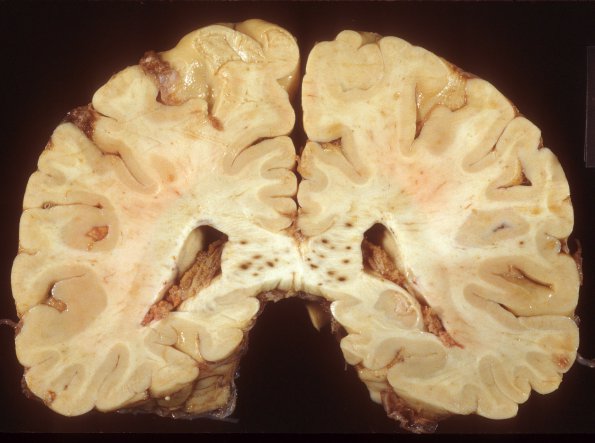 5A2 CMV Encephalitis SP lung transplant (Case 5) 2