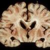 6A AIDS Encephalitis, WM-GM & CMV (Case 6)