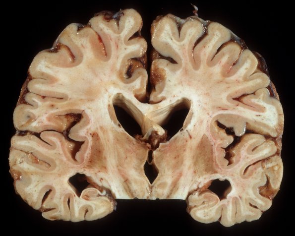 6A AIDS Encephalitis, WM-GM & CMV (Case 6)