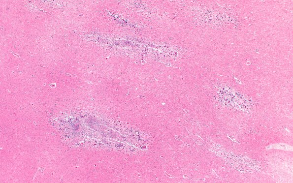 6B1 Encephalitis, HIV leukoencephalitis, CMV (Case 6) N12 H&E 1