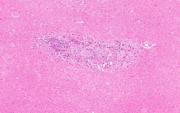 6B2 Encephalitis, HIV leukoencephalitis, CMV (Case 6) N12 H&E 3