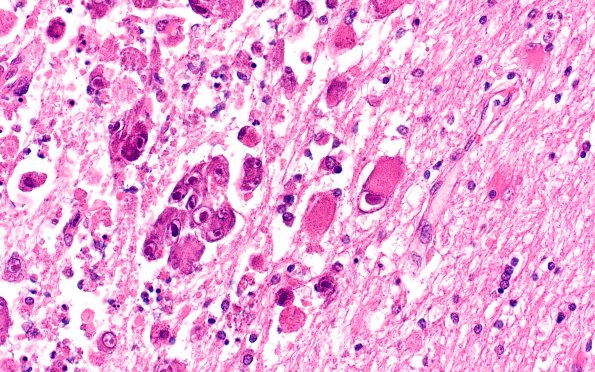 6B3 Encephalitis, HIV leukoencephalitis, CMV (Case 6) N12 H&E 2