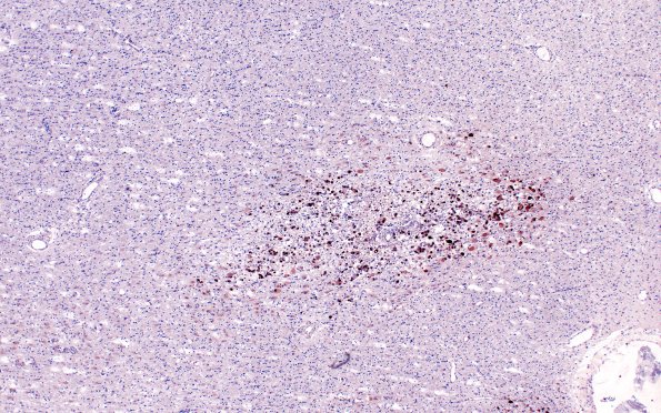 6C1 Encephalitis, HIV leukoencephalitis, CMV (Case 6) N12 CMV IHC 7