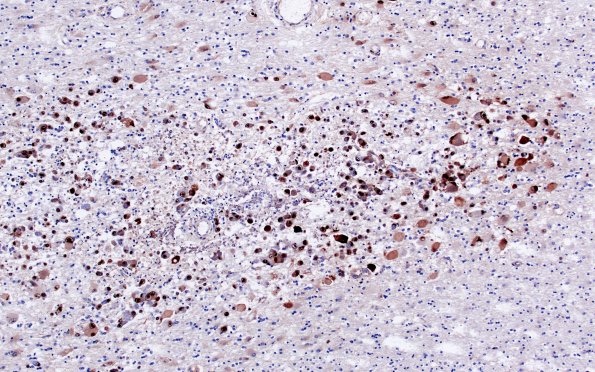 6C2 Encephalitis, HIV leukoencephalitis, CMV (Case 6) N12 CMV IHC 3