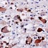 6C3 Encephalitis, HIV leukoencephalitis, CMV (Case 6) N12 CMV IHC 5