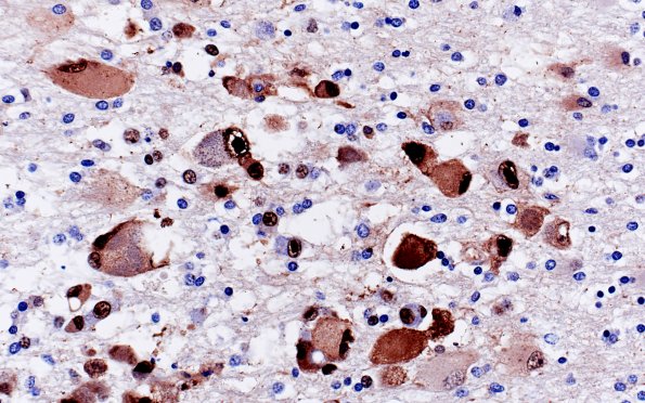 6C3 Encephalitis, HIV leukoencephalitis, CMV (Case 6) N12 CMV IHC 5