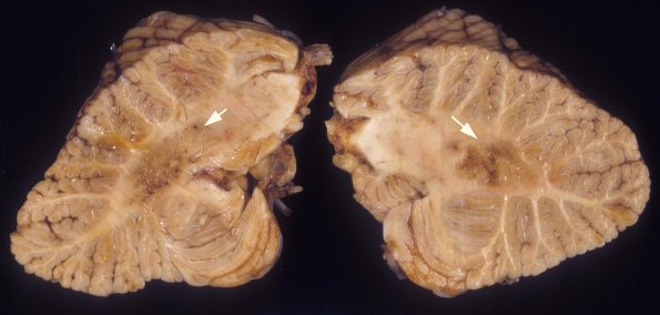 7A HIV, CMV (Case 7) A1 copy