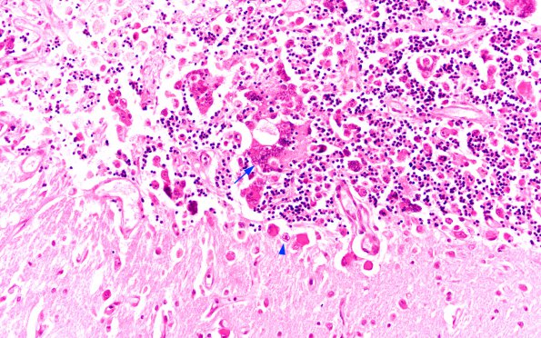 7B3 CMV, cerebellum N9b (Case 7) H&E 5 copy