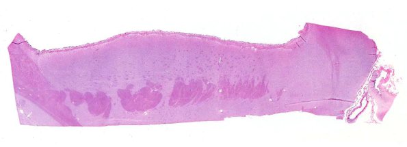 9A1 CMV Ependymitis (AANP 1965, Case 10) H&E X0.3