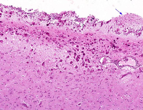 9A3 CMV Ependymitis (AANP 1965, Case 10) H&E X10 1 copy