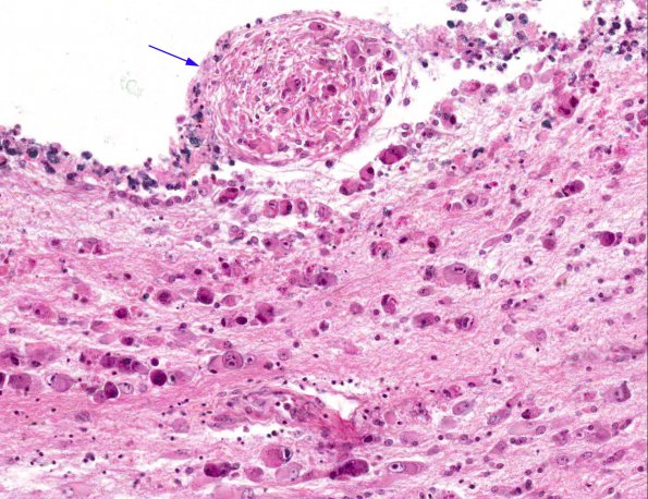 9A5 CMV Ependymitis (AANP 1965, Case 10) H&E X20 11 copy