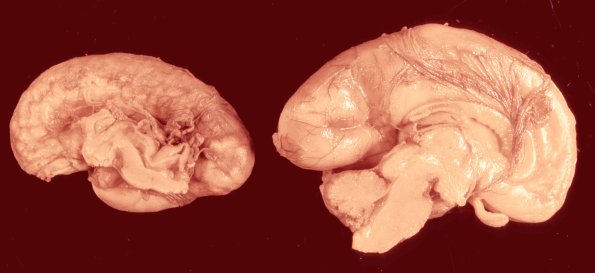 1A1 CMV (Case 1) 1 Intrauterine vs normal ExpA