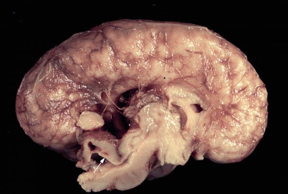 1A2 CMV (Case 1) 2 Intrauterine A copy A