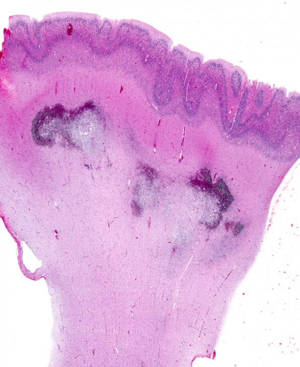 1B2 TORCH Agent & Polymicrogyria (Case 6) H&E whole mount