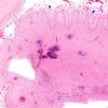 1B3 Encephalitis, CMV (Case 1) 2X copy