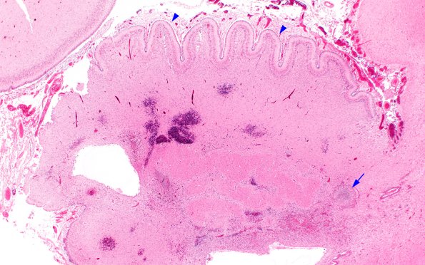 1B3 Encephalitis, CMV (Case 1) 2X copy