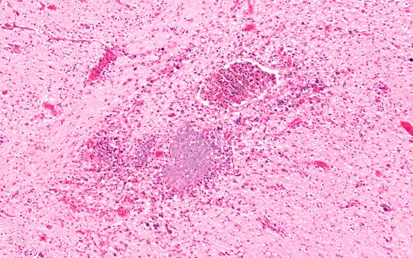 1B4 Encephalitis, CMV (Case 1) 6