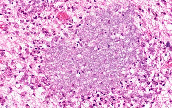 1B5 Encephalitis, CMV (Case 1) 5