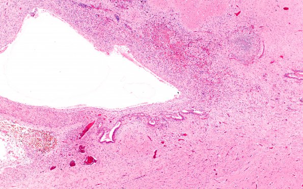 1B7 Encephalitis, CMV (Case 1) 8